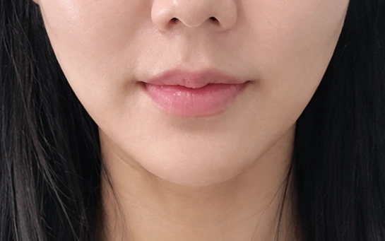 미니리프팅 후