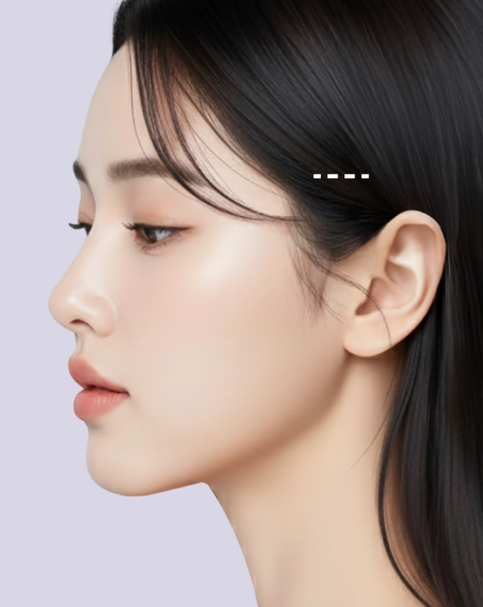 헤어라인과 귀 주변 절개 디자인